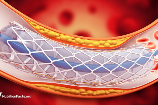 Why Use Stents When They Don’t Work? 