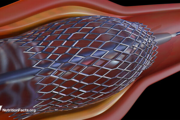 Heart Stents and Their Risks 