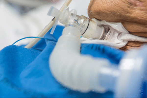 CCP Podcast: When to do the tracheostomy