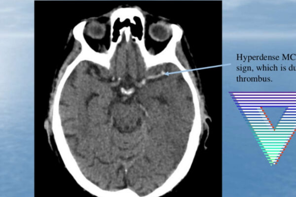 Blood or brain? Head CT updates