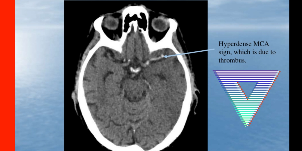 Blood or brain? Head CT updates