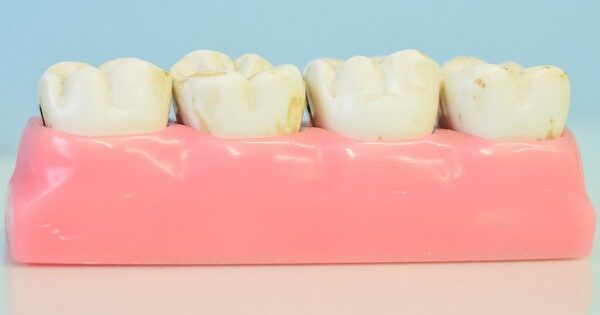 8 Natural Ways to Fight Back Against Tooth Plaque