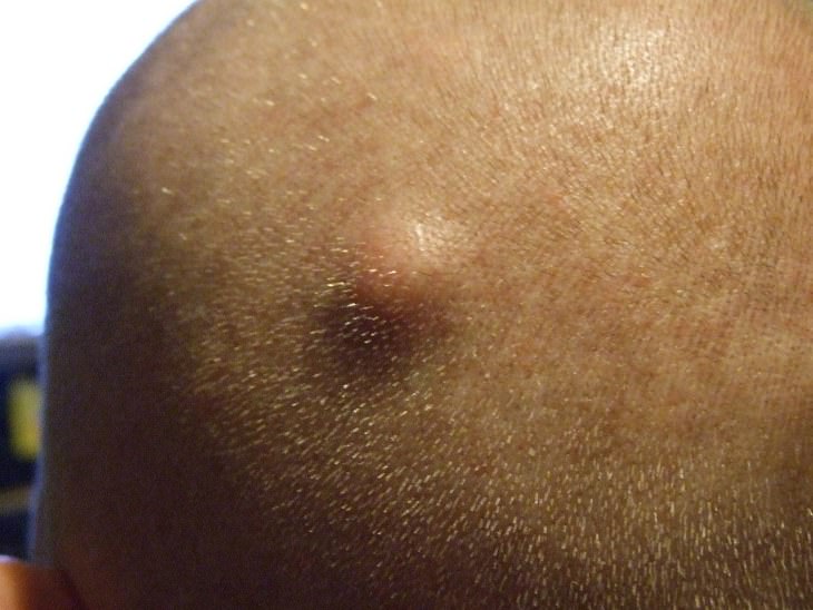 Learn How to Diagnose and Treat a Skin Bump