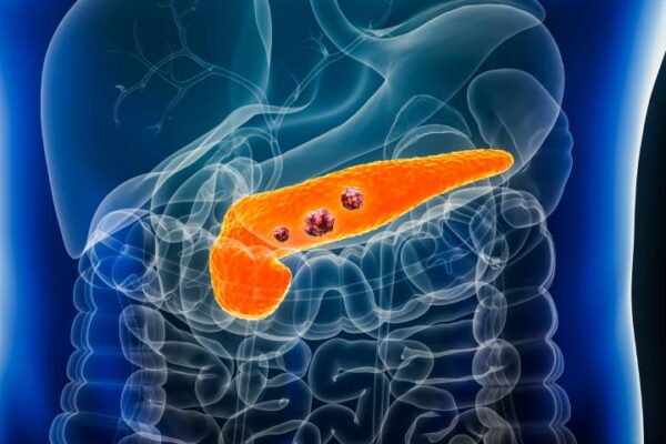 Pancreatic Cancer | Best Pancreatic Cancer Hospital In Pune