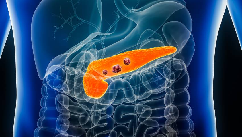 Pancreatic Cancer | Best Pancreatic Cancer Hospital In Pune