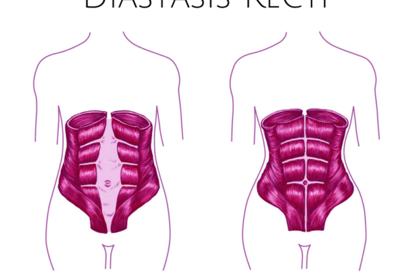 How to Check for Diastasis Recti