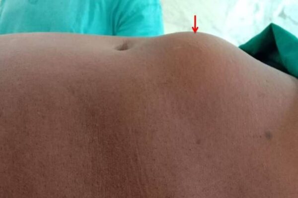 Silent Signs That You Have Hernia