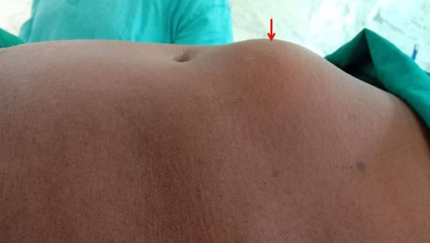 Silent Signs That You Have Hernia