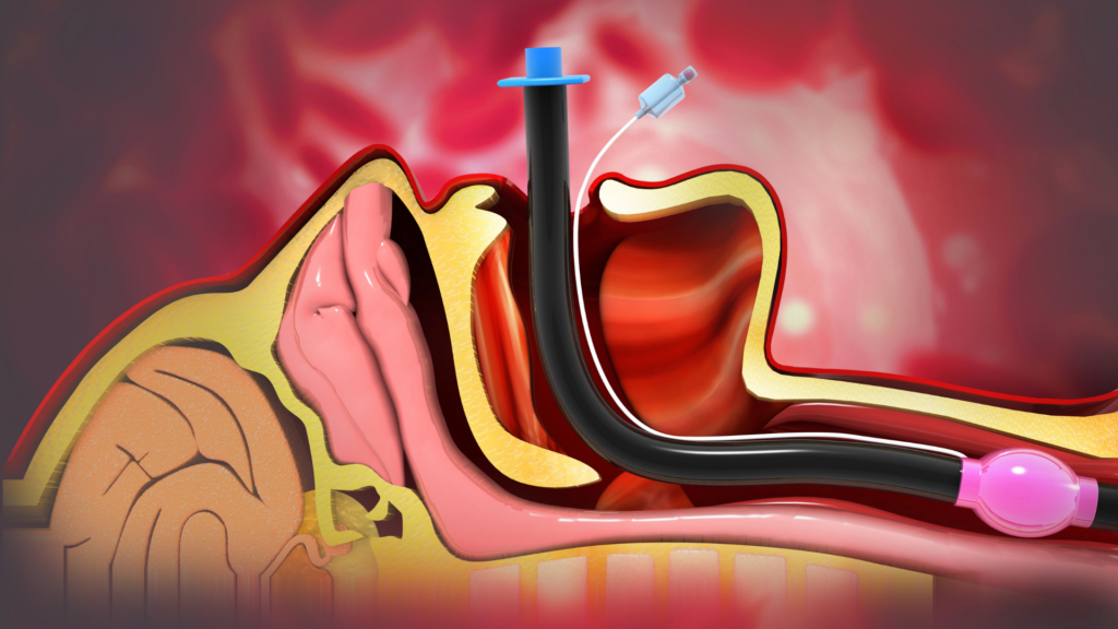 Why do we Intubate?