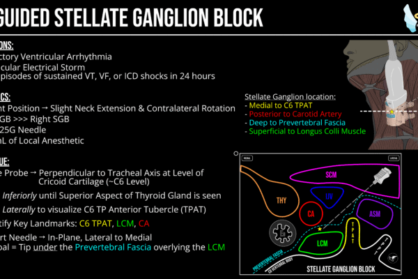 EMCrit 395 – Stellate Ganglion Block