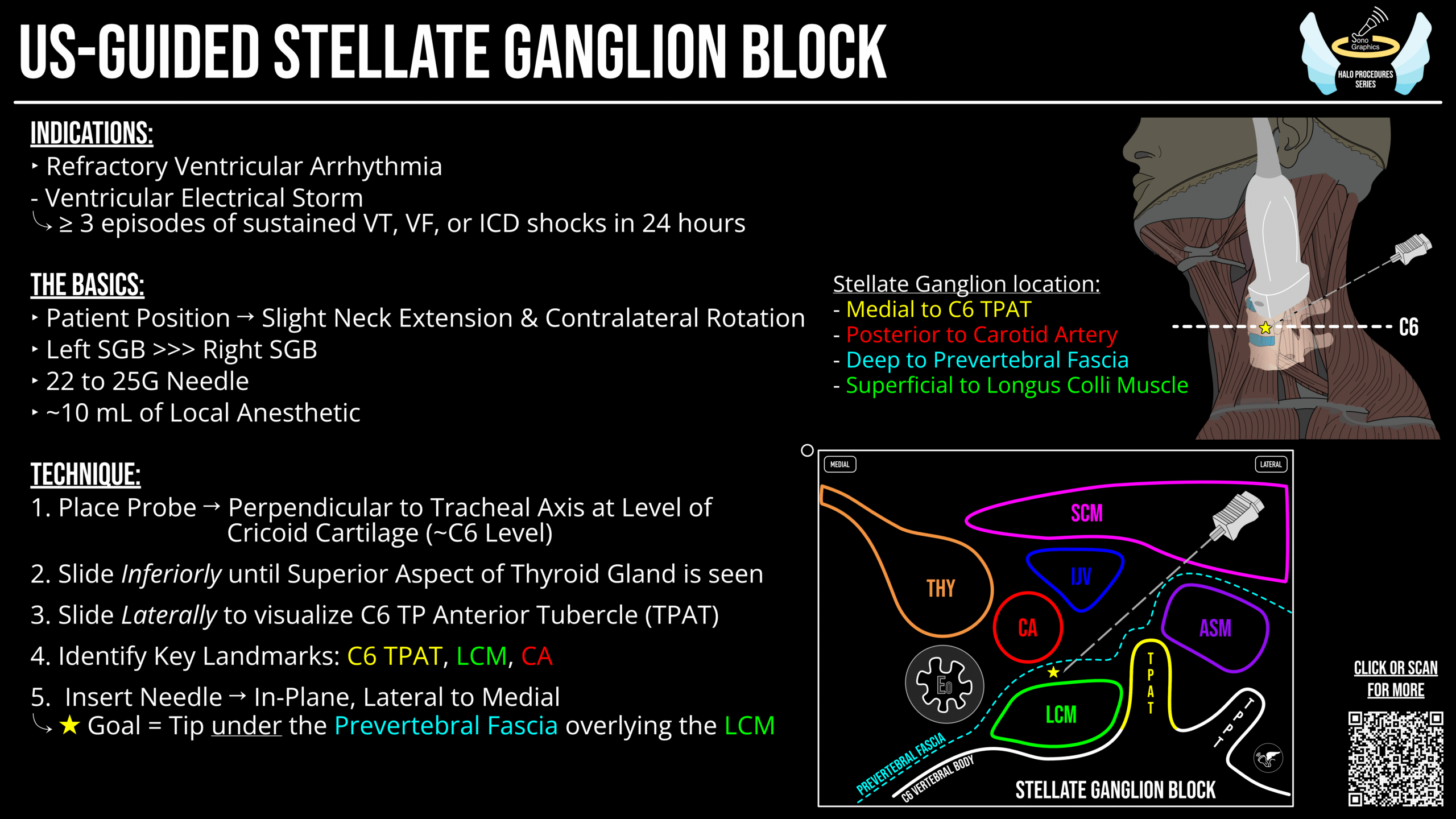 EMCrit 395 – Stellate Ganglion Block