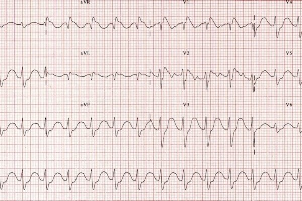 Critical Care Anywhere: Clinical Pearl 71: The TOXIC EKG