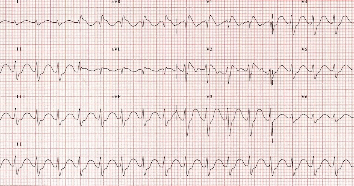 Critical Care Anywhere: Clinical Pearl 71: The TOXIC EKG