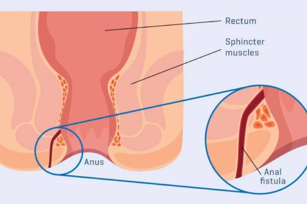 Treatment of Fistula – Laser Surgery