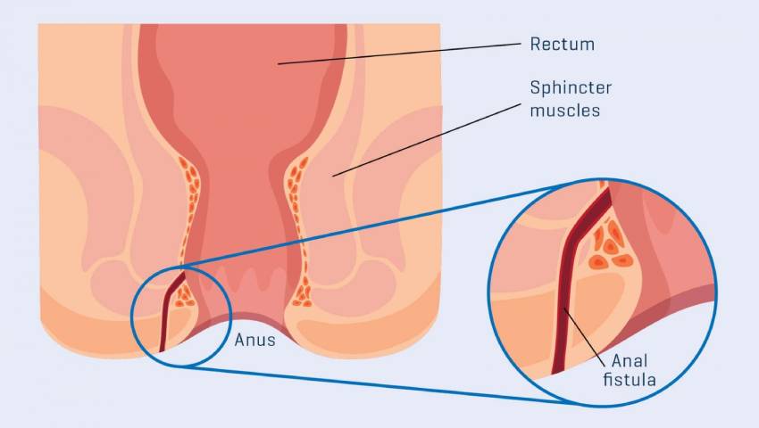Treatment of Fistula – Laser Surgery