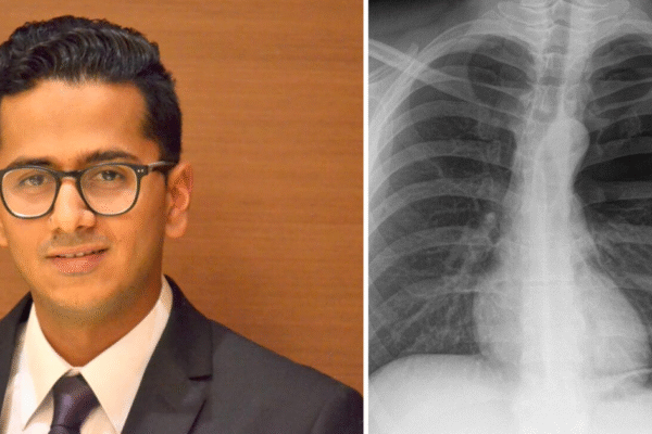 Lung Cancer- 6 Common Signs That You May Be at Risk