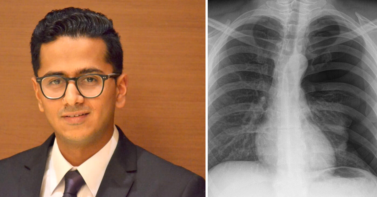 Lung Cancer- 6 Common Signs That You May Be at Risk