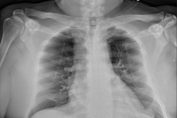 7. Case of the month: Pulmonary Embolism
