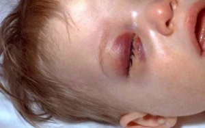 Reasons To Vaccinate Your Child #6