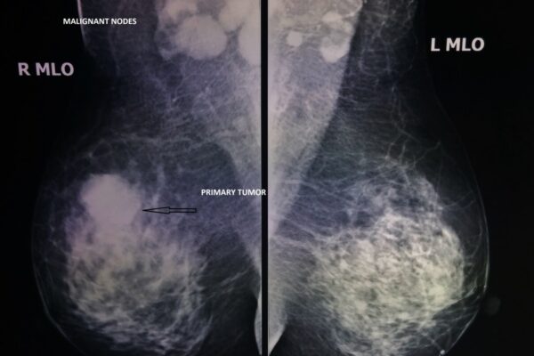 All underarm lumps are not cancerous