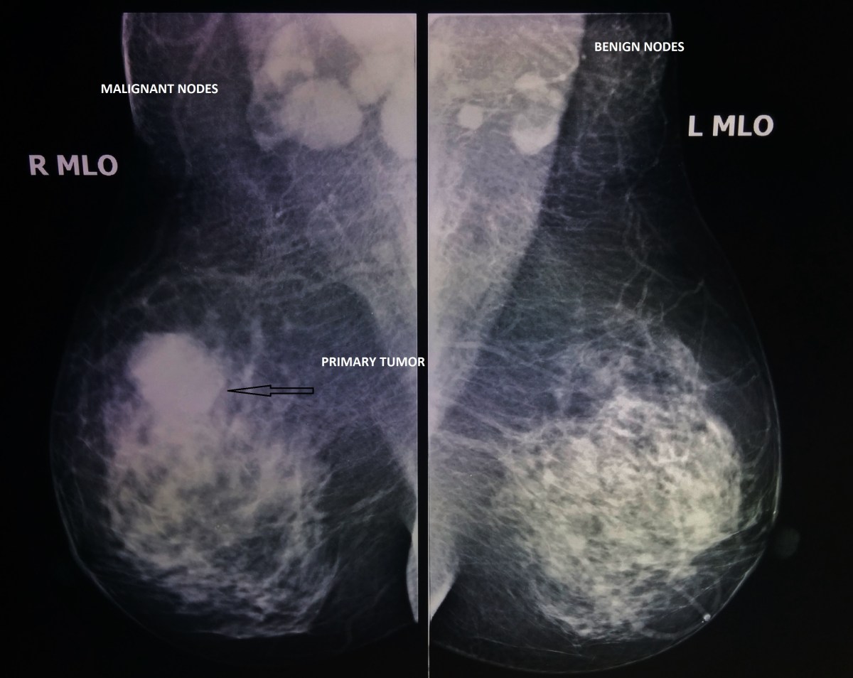 All underarm lumps are not cancerous