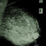 All breast fibroadenomas don’t require surgery