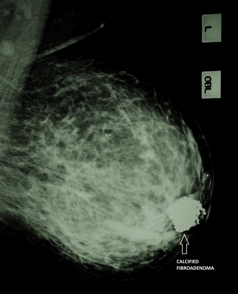 All breast fibroadenomas don’t require surgery