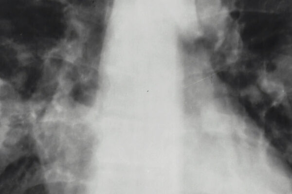 Severe community-acquired pneumonia (sCAP) 2025 update