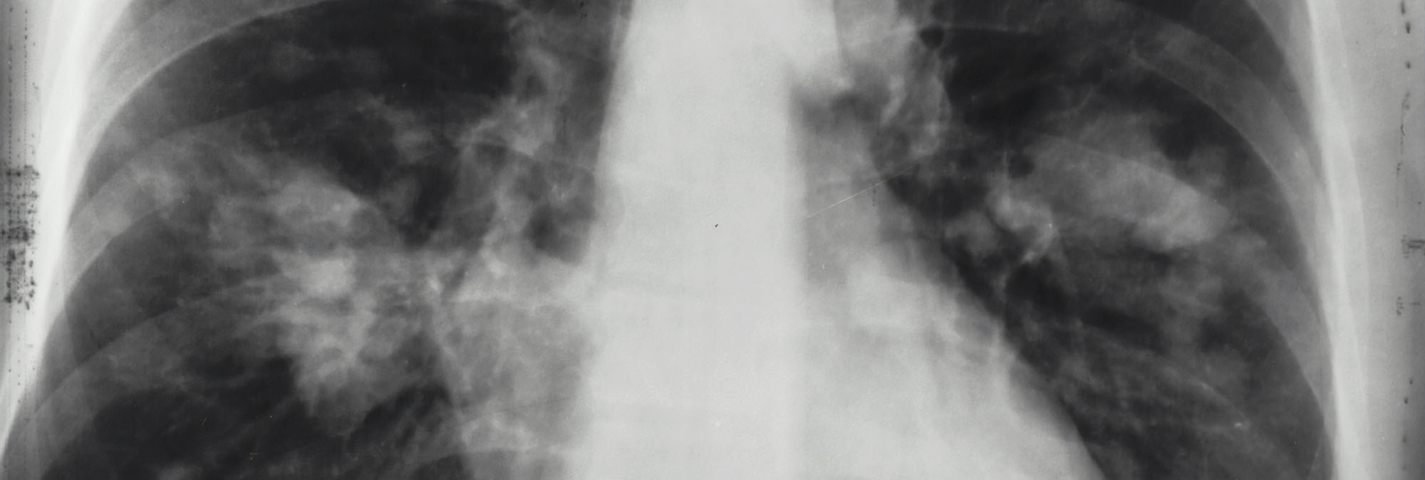Severe community-acquired pneumonia (sCAP) 2025 update