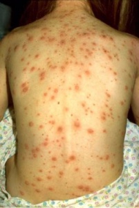 Reasons To Vaccinate Your Child #10
