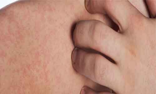 Type II cryoglobulinemic vasculitis associated with poor prognosis in patients with Sjögren disease: JAMA