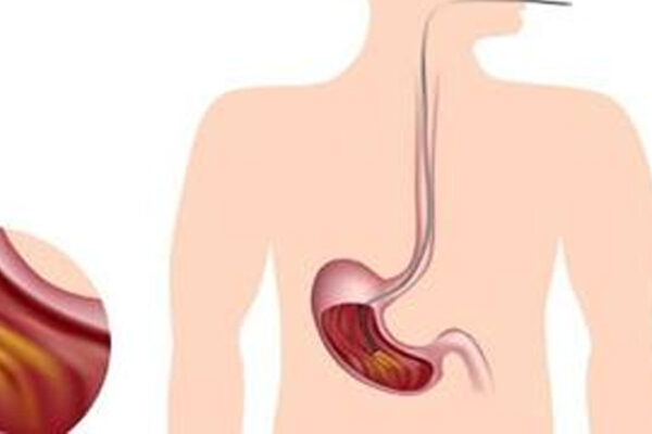 Endoscopy Every Three Years Cuts Gastric Cancer Death Risk: Cohort Study