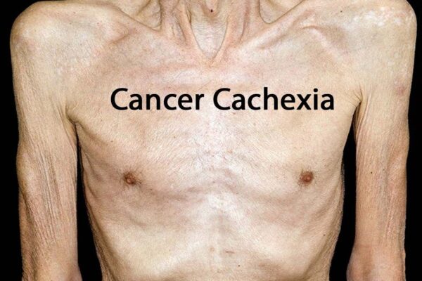 Cachexia index as a Biomarker for Cancer Cachexia and Quality of Life in Gastric Cancer: Study