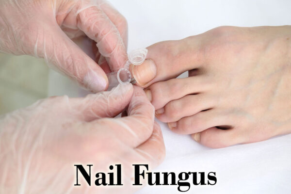 Efinaconazole 10% Proven Safe and Effective for Toenail Fungus in Older Adults: Study