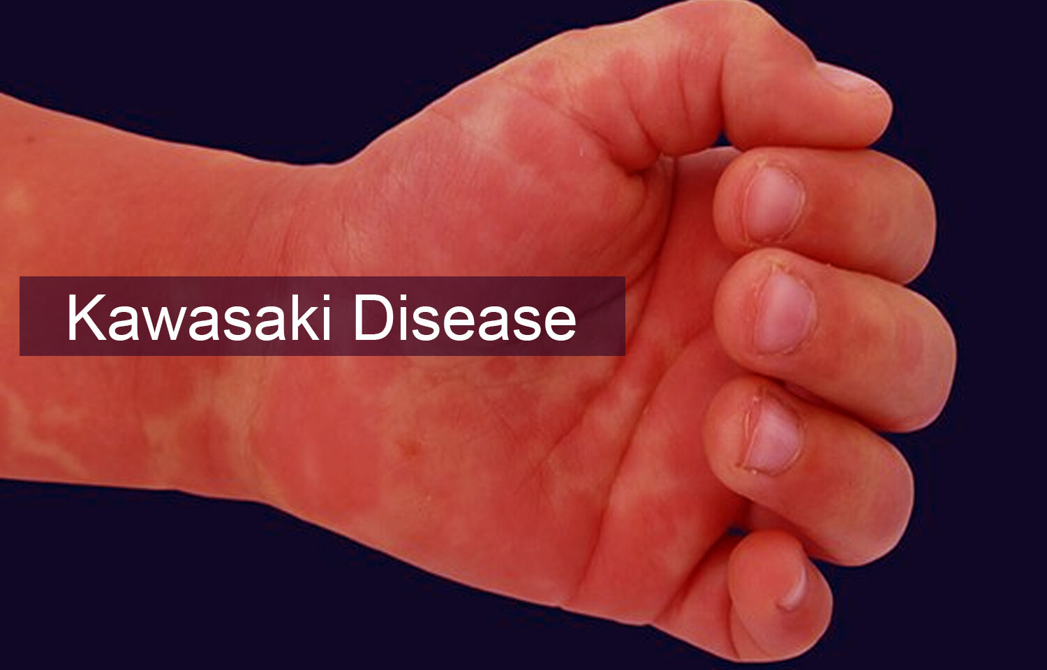 Patients with Kawasaki disease have increased risk of allergic diseases: BMC