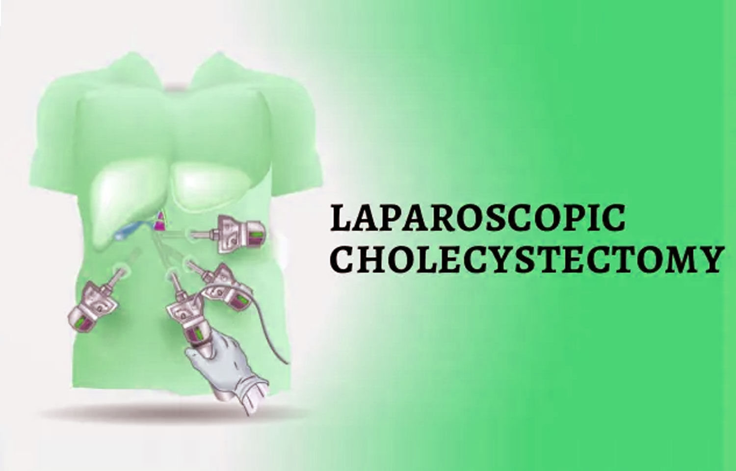 Laparoscopic Cholecystectomy Safe and Feasible in Pregnancy: Study