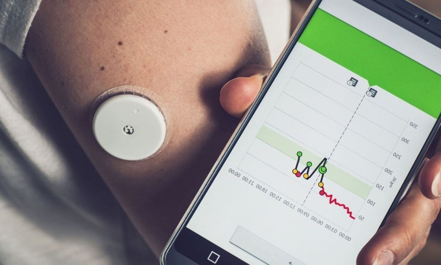 CGM Metrics Strongly Predict 5-Year Mortality Risk in Diabetes, Study Shows