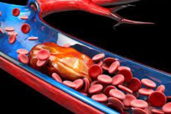 Adjunctive Argatroban or Eptifibatide Shows No Benefit with Thrombolysis in Thrombectomy Patients: JAMA