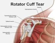 Early Signs Of Rotator Cuff Damage