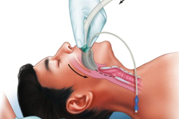Study evaluates Impact of 3D CT and Virtual Endoscopy on Airway Management in Head and Neck Cancer