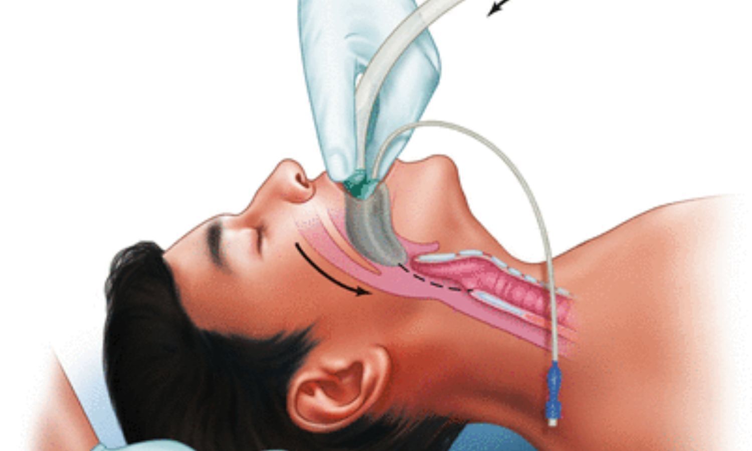 Study evaluates Impact of 3D CT and Virtual Endoscopy on Airway Management in Head and Neck Cancer
