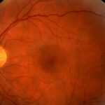 Study Links High Stress Hyperglycemia Ratio to Diabetic Retinopathy Progression and Post-Surgery Complications