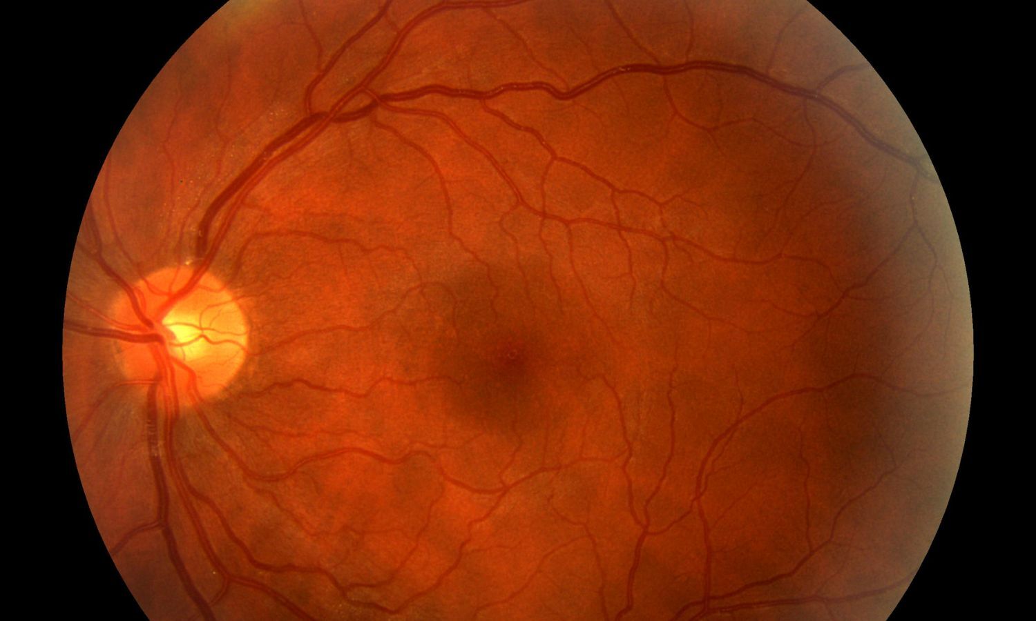 Study Links High Stress Hyperglycemia Ratio to Diabetic Retinopathy Progression and Post-Surgery Complications
