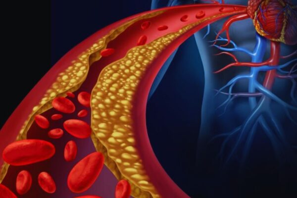 High Coronary Artery Calcium in Type 1 Diabetes Patients Despite Good Control, Study Finds