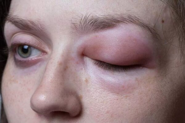 Lanadelumab significantly reduces HAE attacks in long-term use: Study