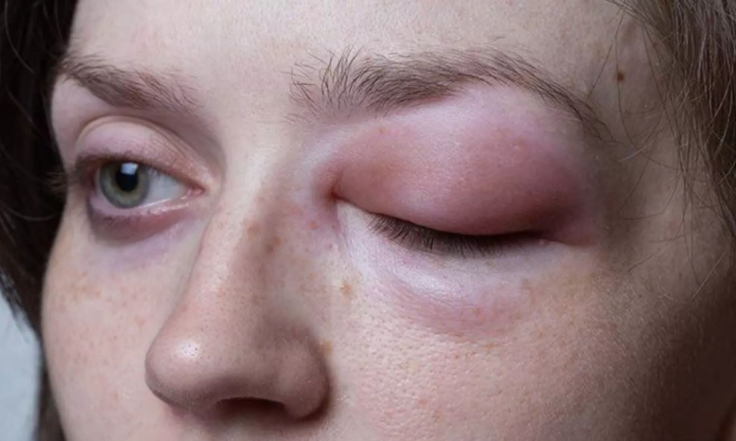 Lanadelumab significantly reduces HAE attacks in long-term use: Study