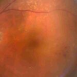 Red Cell Distribution Width-to-Albumin Ratio Shows Nonlinear Link With Retinopathy Risk: Study