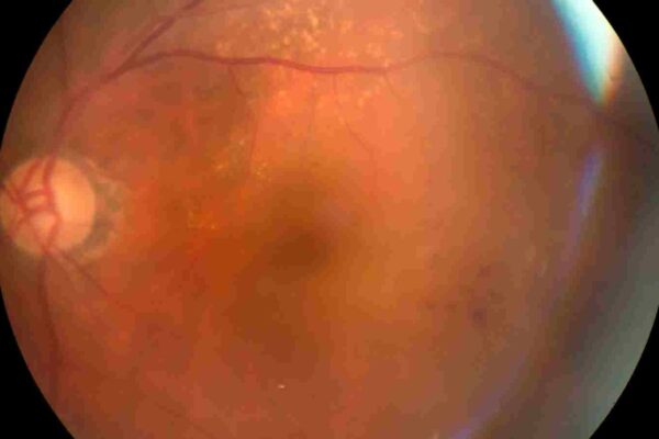 Red Cell Distribution Width-to-Albumin Ratio Shows Nonlinear Link With Retinopathy Risk: Study Red Cell Distribution Width-to-Albumin Ratio Shows Nonlinear Link With Retinopathy Risk: Study