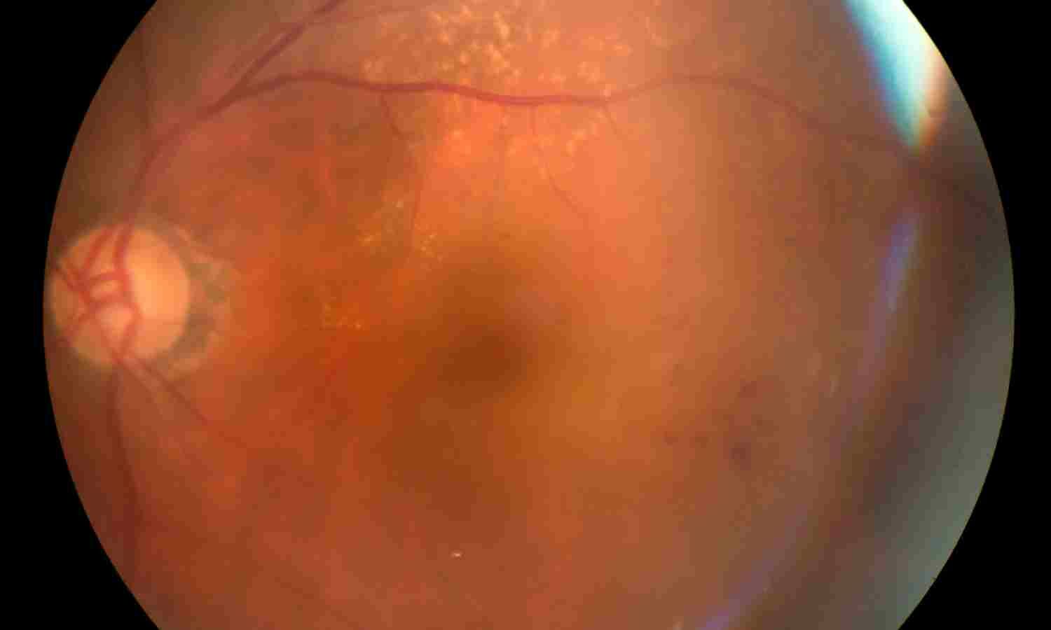 Red Cell Distribution Width-to-Albumin Ratio Shows Nonlinear Link With Retinopathy Risk: Study
