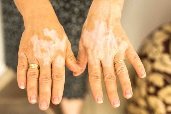 Vitiligo Causally Linked to Rheumatoid Arthritis, Type 1 Diabetes, and Alopecia Areata: Study Vitiligo Causally Linked to Rheumatoid Arthritis, Type 1 Diabetes, and Alopecia Areata: Study